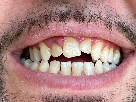 Before a smile makeover