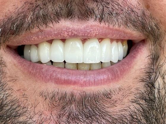 After a smile makeover